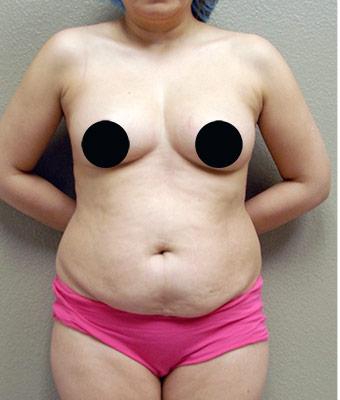 Tummy Tuck Before & After Patient #1203