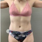 Tummy Tuck Before & After Patient #1203