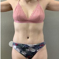 Tummy Tuck Before & After Patient #1203
