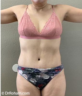 Tummy Tuck Before & After Patient #1203