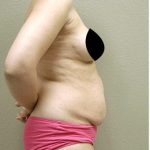 Tummy Tuck Before & After Patient #1203