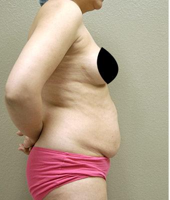 Tummy Tuck Before & After Patient #1203