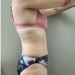 Tummy Tuck Before & After Patient #1203