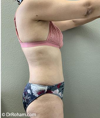 Tummy Tuck Before & After Patient #1203