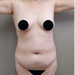 Tummy Tuck Before & After Patient #1204