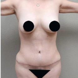 Tummy Tuck Before & After Patient #1204