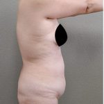 Tummy Tuck Before & After Patient #1204