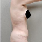 Tummy Tuck Before & After Patient #1204