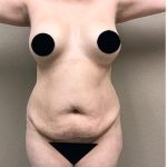 Tummy Tuck Before & After Patient #1205