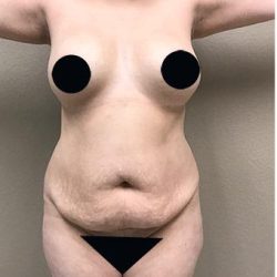 Tummy Tuck Before & After Patient #1205