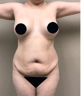 Tummy Tuck Before & After Patient #1205