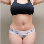 Tummy Tuck Before & After Patient #1205