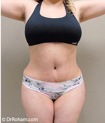 Tummy Tuck Before & After Patient #1205
