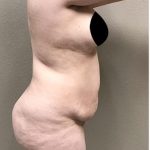 Tummy Tuck Before & After Patient #1205