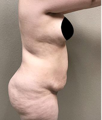 Tummy Tuck Before & After Patient #1205