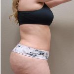 Tummy Tuck Before & After Patient #1205