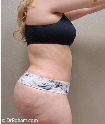Tummy Tuck Before & After Patient #1205
