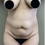 Tummy Tuck Before & After Patient #1206