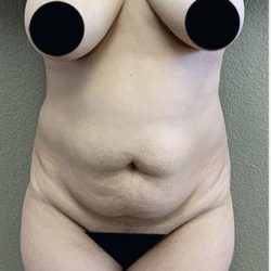 Tummy Tuck Before & After Patient #1206