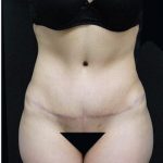 Tummy Tuck Before & After Patient #1206