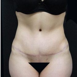Tummy Tuck Before & After Patient #1206