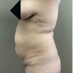 Tummy Tuck Before & After Patient #1206