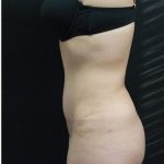 Tummy Tuck Before & After Patient #1206