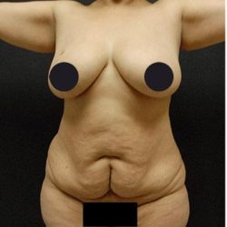 Tummy Tuck Before & After Patient #1207