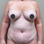 Tummy Tuck Before & After Patient #1208