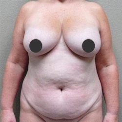 Tummy Tuck Before & After Patient #1208