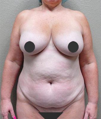 Tummy Tuck Before & After Patient #1208