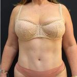 Tummy Tuck Before & After Patient #1208