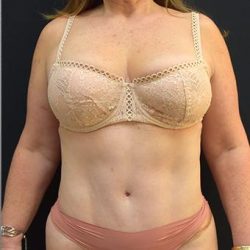 Tummy Tuck Before & After Patient #1208