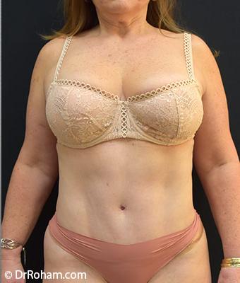 Tummy Tuck Before & After Patient #1208
