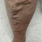 Varicose Spider Vein Removal Before & After Patient #1423