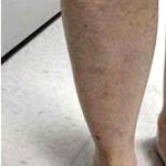 Varicose Spider Vein Removal Before & After Patient #1423