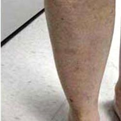 Varicose Spider Vein Removal Before & After Patient #1423