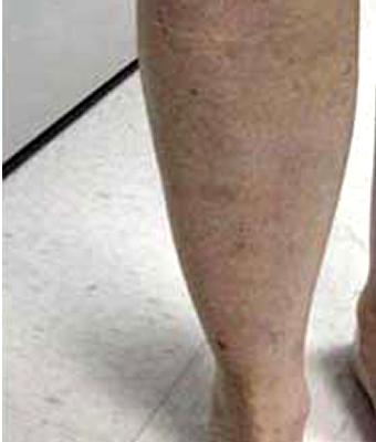 Varicose Spider Vein Removal Before & After Patient #1423