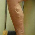 Varicose Spider Vein Removal Before & After Patient #1424