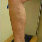Varicose Spider Vein Removal Before & After Patient #1424