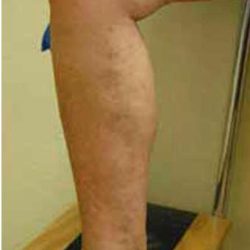 Varicose Spider Vein Removal Before & After Patient #1424