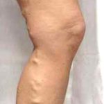 Varicose Spider Vein Removal Before & After Patient #1425