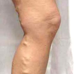 Varicose Spider Vein Removal Before & After Patient #1425