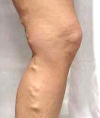 Varicose Spider Vein Removal Before & After Patient #1425