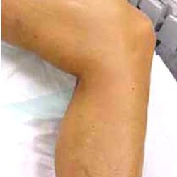 Varicose Spider Vein Removal Before & After Patient #1425