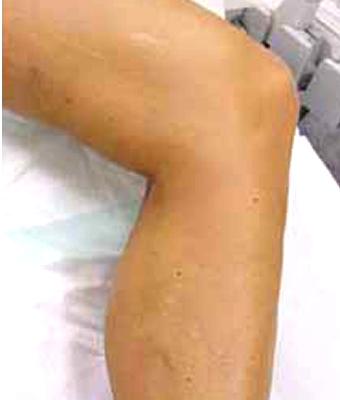 Varicose Spider Vein Removal Before & After Patient #1425