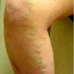 Varicose Spider Vein Removal Before & After Patient #1426