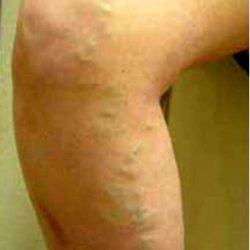 Varicose Spider Vein Removal Before & After Patient #1426