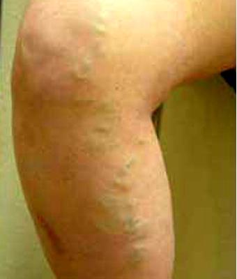 Varicose Spider Vein Removal Before & After Patient #1426