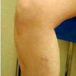 Varicose Spider Vein Removal Before & After Patient #1426